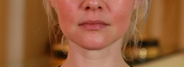 rosacea-grau1-intensa